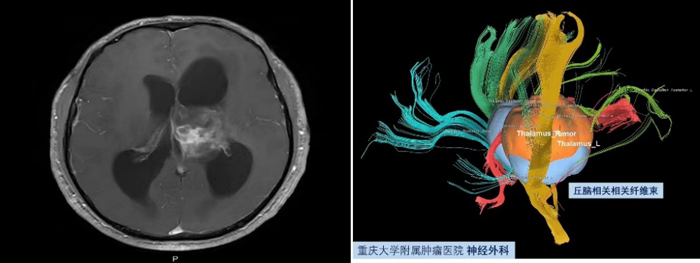 【萊沃醫(yī)療：行業(yè)分享】重慶大學(xué)附屬腫瘤醫(yī)院神經(jīng)外科手術(shù)集錦腦部牽開導(dǎo)引導(dǎo)管下切除腦室丘腦膠質(zhì)瘤